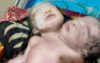 পিরোজপুরে দুই মাথাওয়ালা শিশুর জন্ম